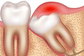 Impaktirani zub/neizrasli zub - da li ukloniti ili ostaviti ?